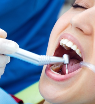 Scaling – Cleaning of teeth and gums